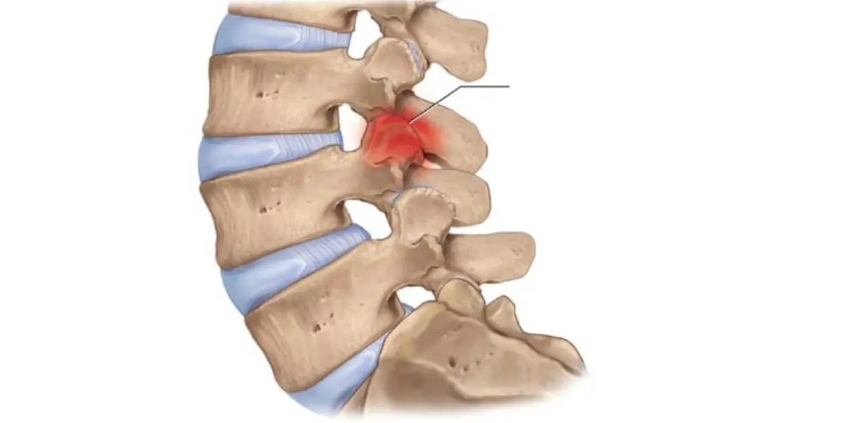 Degeneração Facetária
