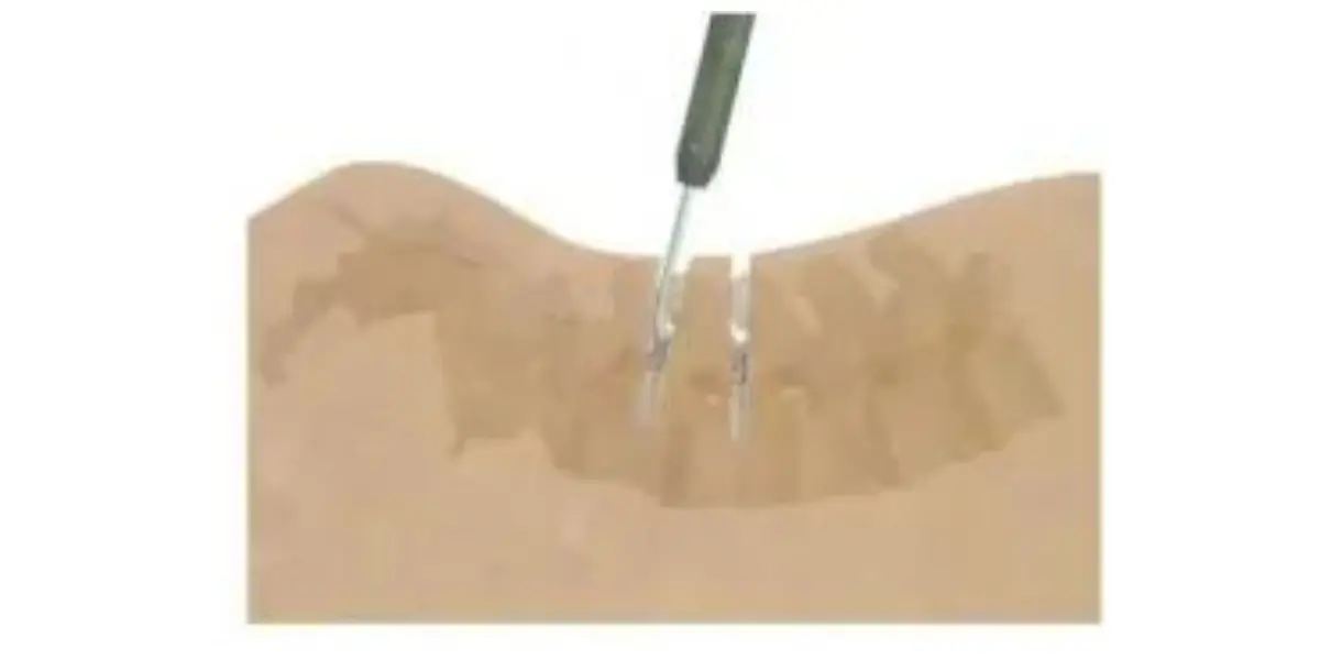 Parafusos Percutâneos