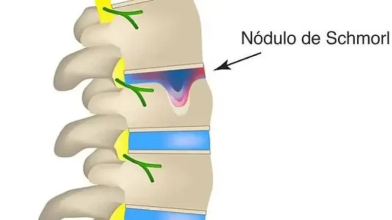 hérnia de Schmorl