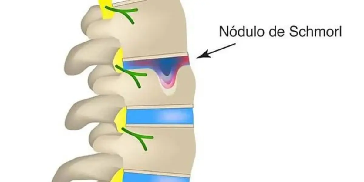 hérnia de Schmorl